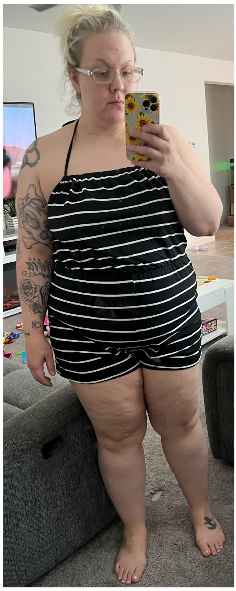 Patients 20-39 Years Old Before & After Gallery - Patient 315662 - Image 1