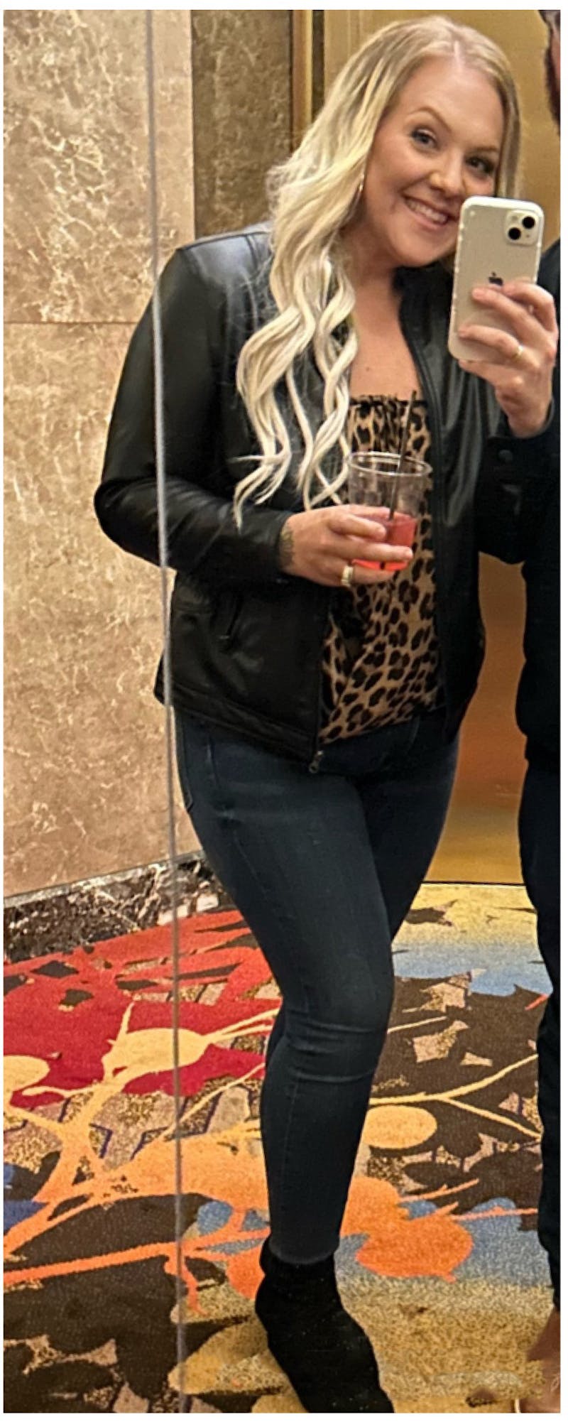 Patients 20-39 Years Old Before & After Gallery - Patient 315662 - Image 2