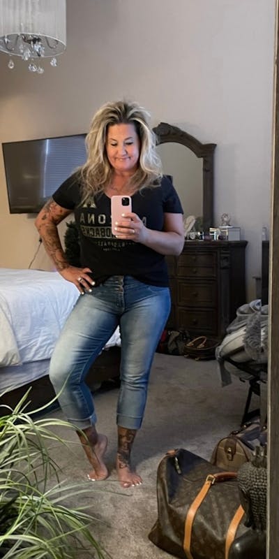 Patients 40-59 Years Old Before & After Gallery - Patient 327531 - Image 1