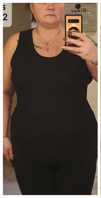 Patients 40-59 Years Old Before & After Gallery - Patient 584771 - Image 1