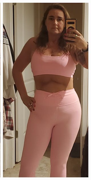 Patients 40-59 Years Old Before & After Gallery - Patient 584771 - Image 2