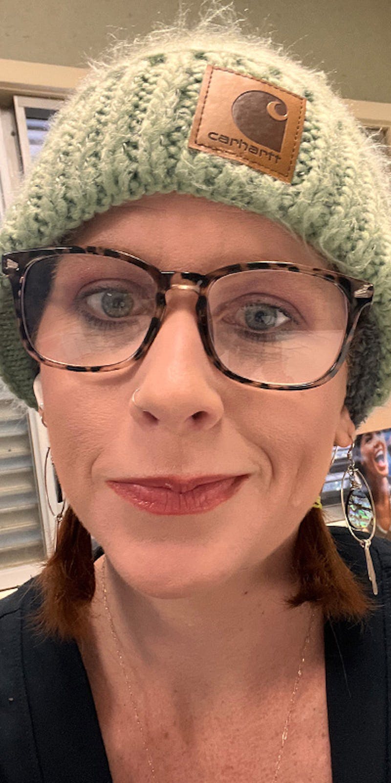 Patients 20-39 Years Old Before & After Gallery - Patient 149205 - Image 2