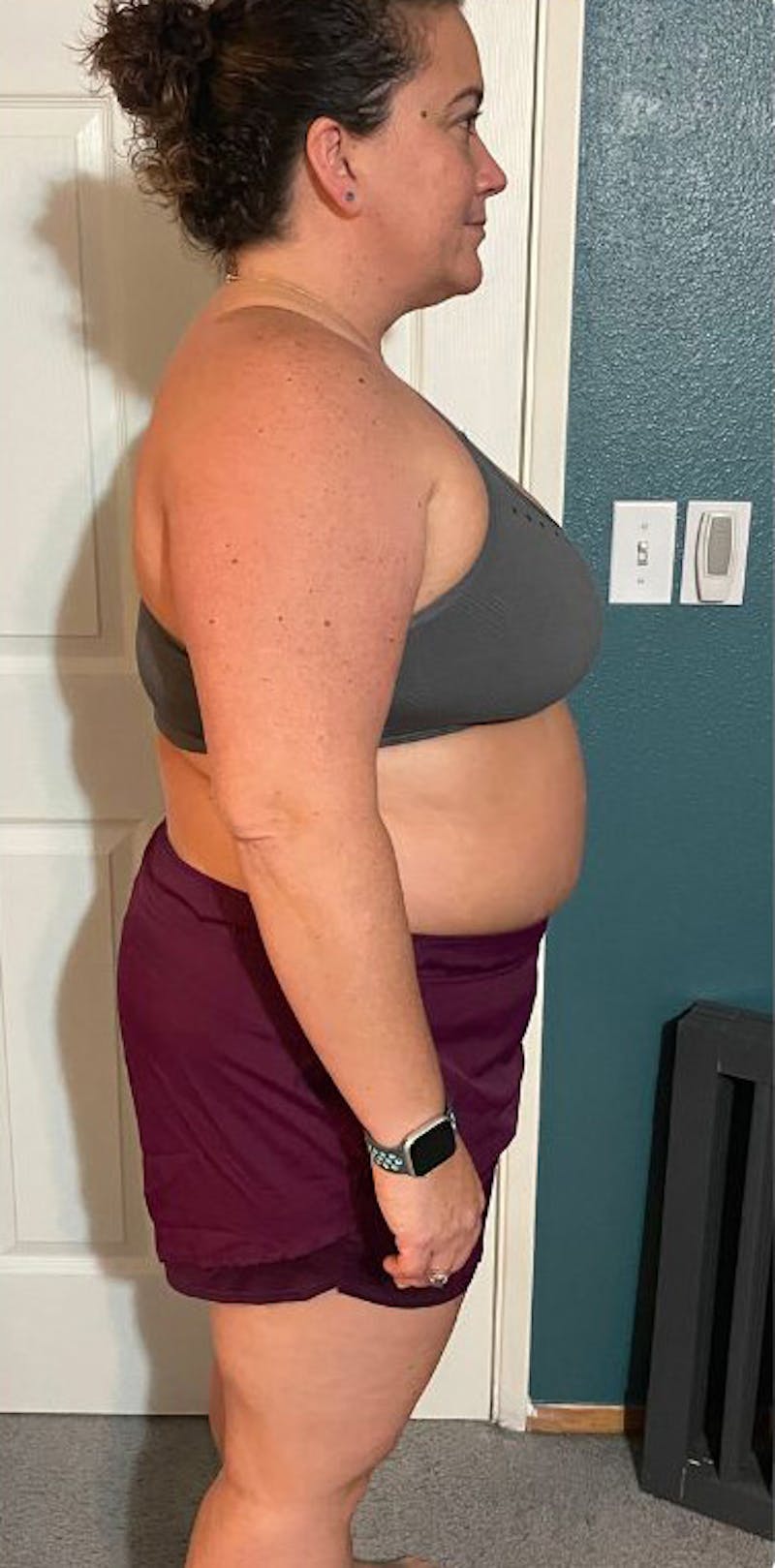 Patients 40-59 Years Old Before & After Gallery - Patient 303987 - Image 1