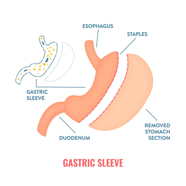 Gastric Sleeve Infographic