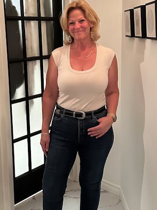 Patients 40-59 Years Old Before & After Gallery - Patient 179181 - Image 2