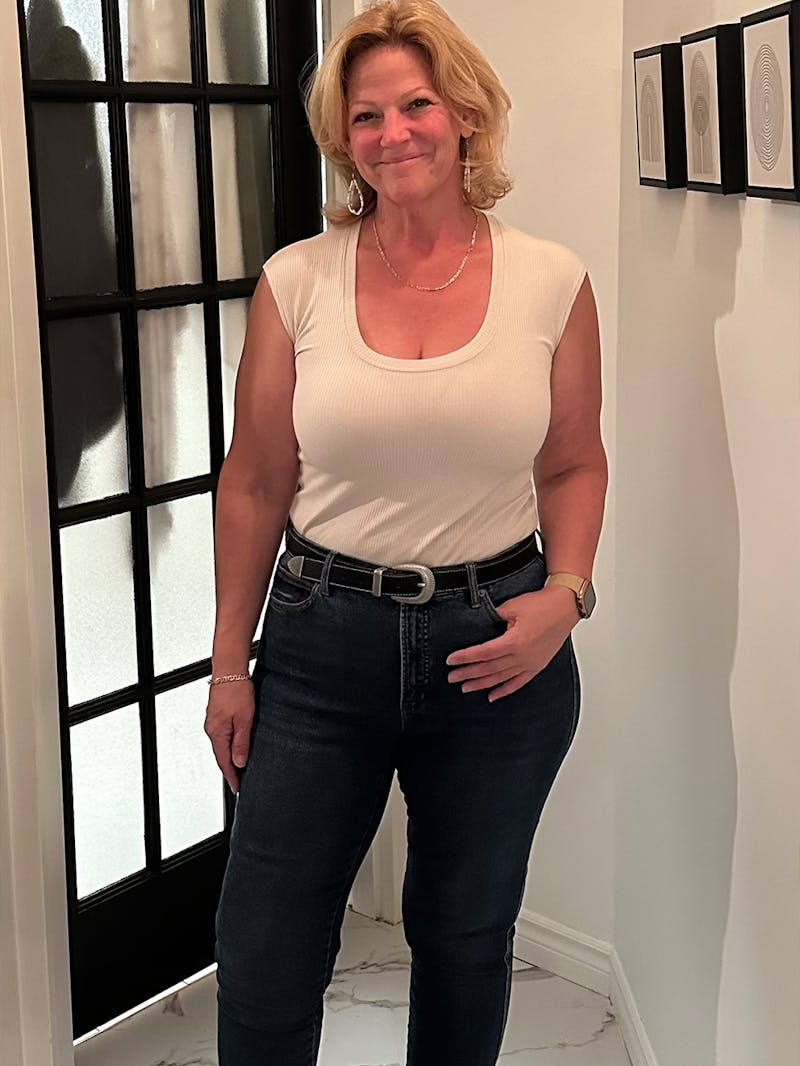 Patients 40-59 Years Old Before & After Gallery - Patient 179181 - Image 2