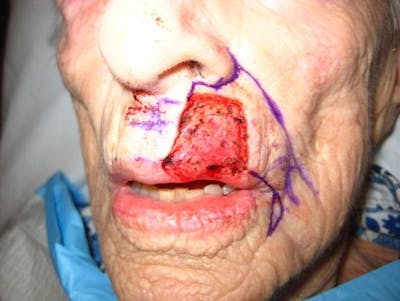 Mohs Reconstruction Before & After Gallery - Patient 29280404 - Image 1