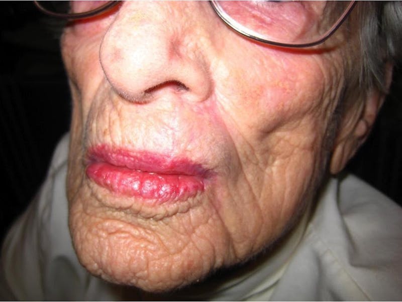 Mohs Reconstruction Before & After Gallery - Patient 29280404 - Image 2