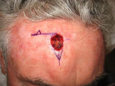 Mohs Surgery Before & After Gallery - Patient 63799214 - Image 1