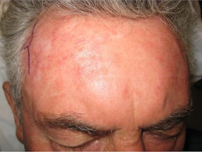 Mohs Surgery Before & After Gallery - Patient 63799214 - Image 2