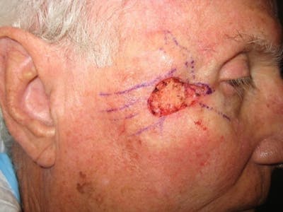 Mohs Surgery Before & After Gallery - Patient 63799215 - Image 1