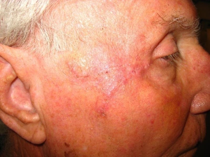 Mohs Surgery Before & After Gallery - Patient 63799215 - Image 2