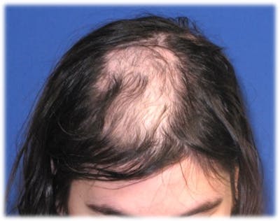 Non-Surgical Before & After Gallery - Patient 31411837 - Image 1