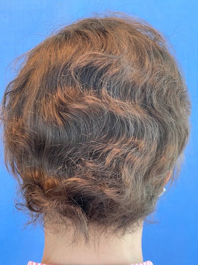 Non-Surgical Before & After Gallery - Patient 31412087 - Image 2