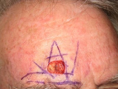 Mohs Surgery Before & After Gallery - Patient 63799212 - Image 1