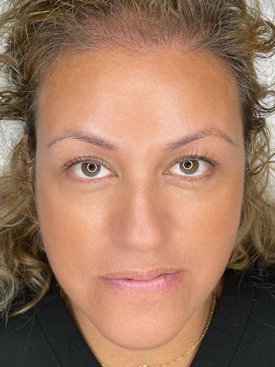 Microblading Before & After Gallery - Patient 41625639 - Image 1