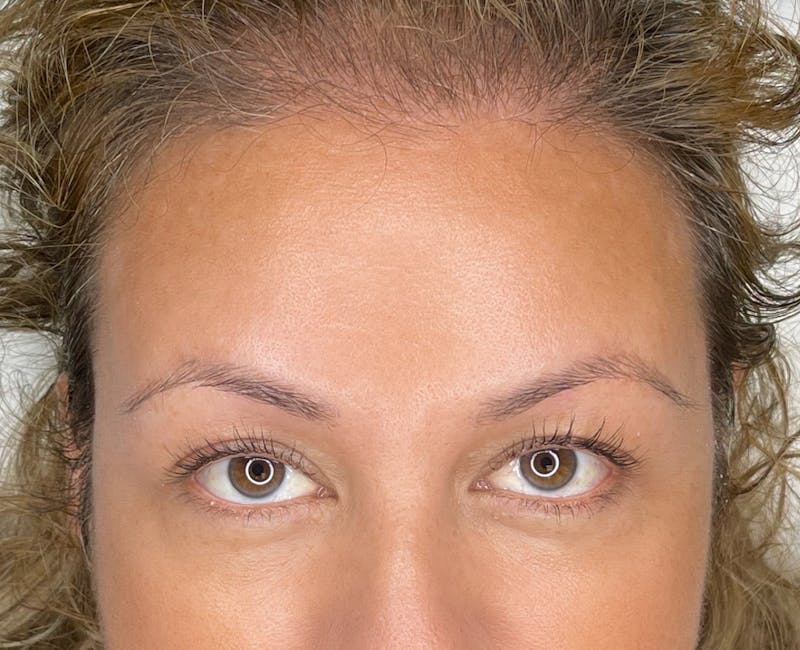 Microblading Before & After Gallery - Patient 41625639 - Image 3