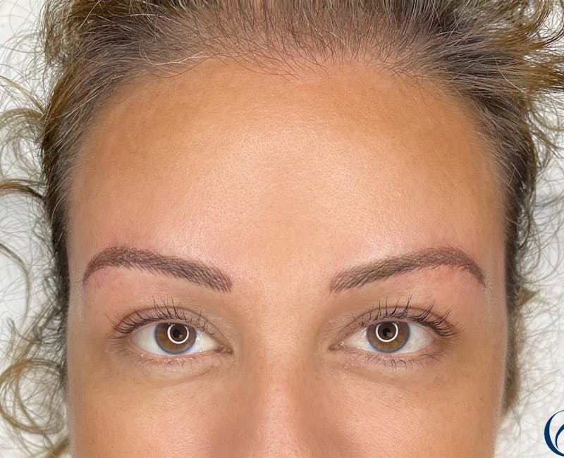 Microblading Before & After Gallery - Patient 41625639 - Image 4