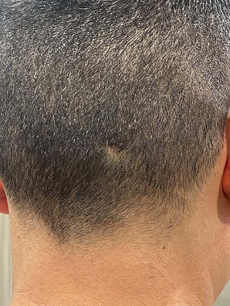 Scalp Micropigmentation Before & After Gallery - Patient 41625680 - Image 1