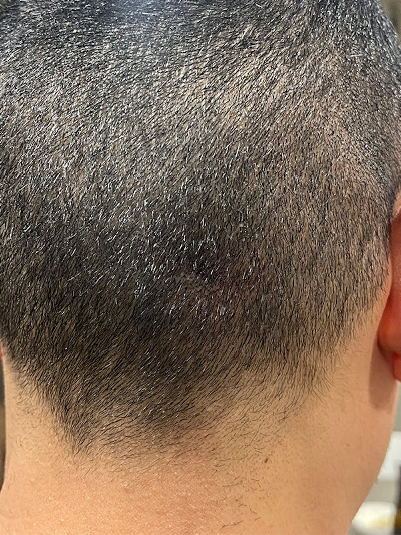 Scalp Micropigmentation Before & After Gallery - Patient 41625680 - Image 2