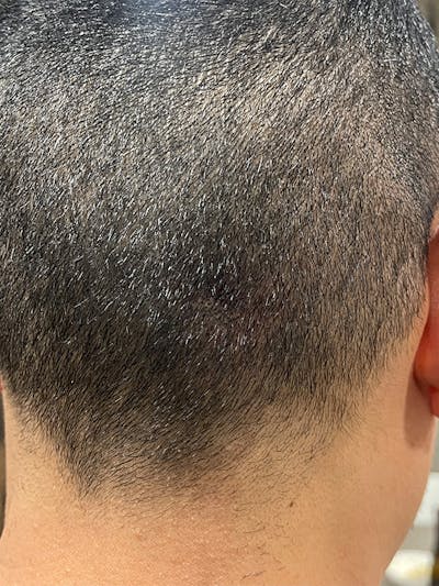 Scalp Micropigmentation Before & After Gallery - Patient 41625680 - Image 2