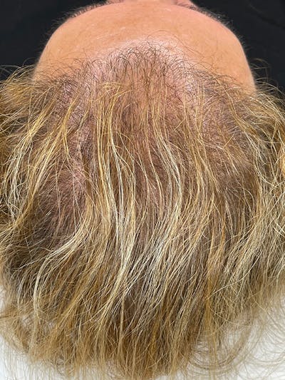Scalp Micropigmentation Before & After Gallery - Patient 41625681 - Image 1