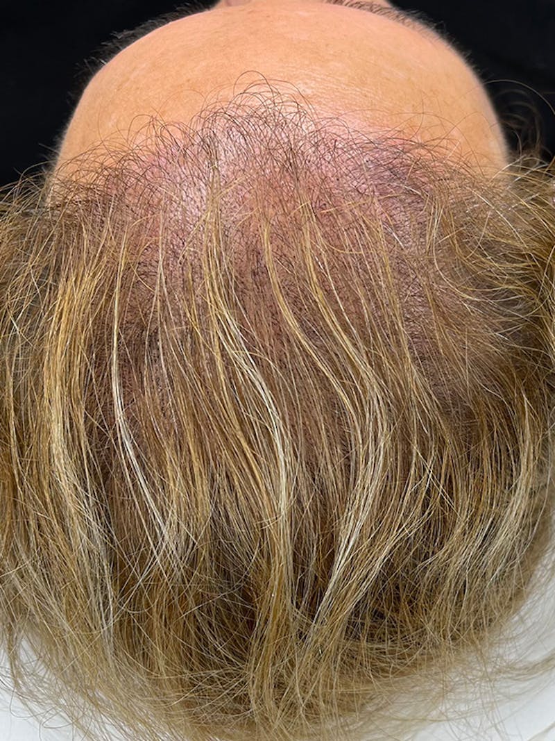 Scalp Micropigmentation Before & After Gallery - Patient 41625681 - Image 2