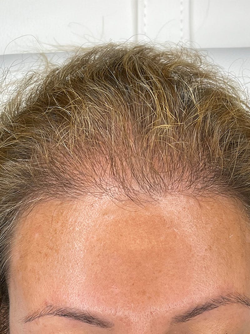Scalp Micropigmentation Before & After Gallery - Patient 41625681 - Image 3