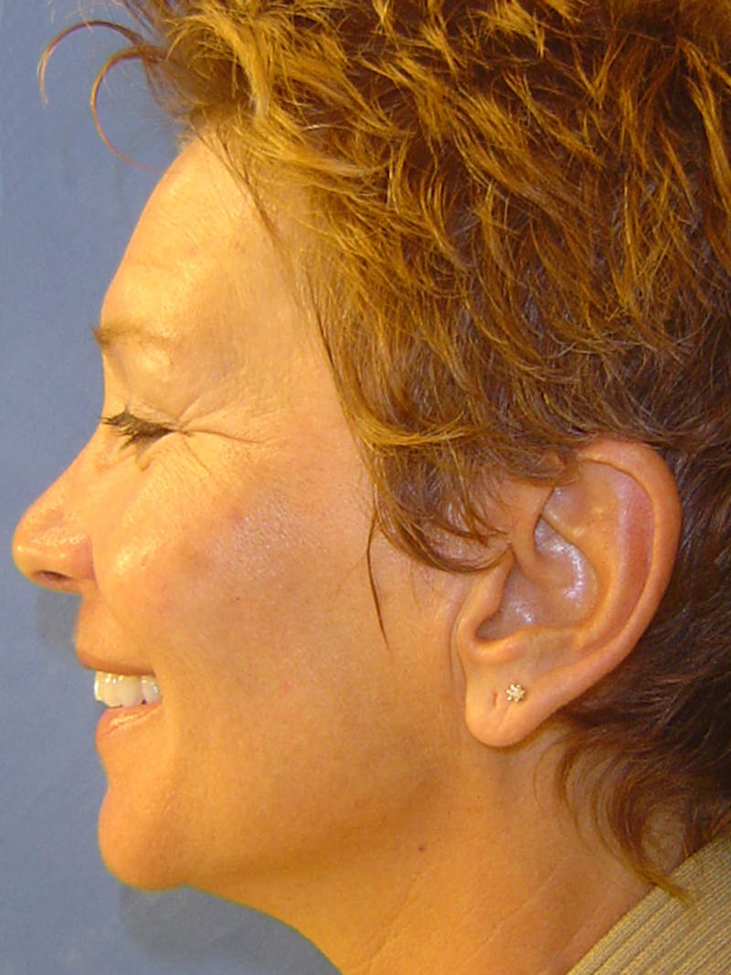 Bio Facial Before & After Gallery - Patient 41625701 - Image 2