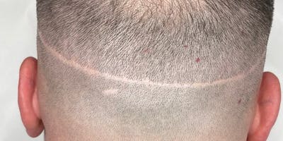 Scalp Micropigmentation Before & After Gallery - Patient 41625682 - Image 1