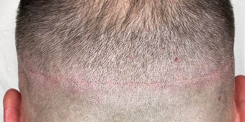 Scalp Micropigmentation Before & After Gallery - Patient 41625682 - Image 2