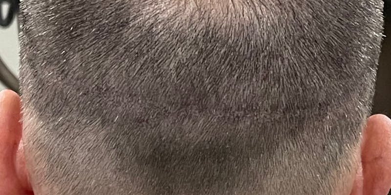 Scalp Micropigmentation Before & After Gallery - Patient 41625682 - Image 4