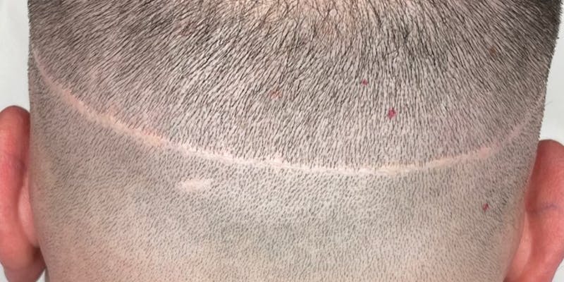 Scalp Micropigmentation Before & After Gallery - Patient 41625682 - Image 5