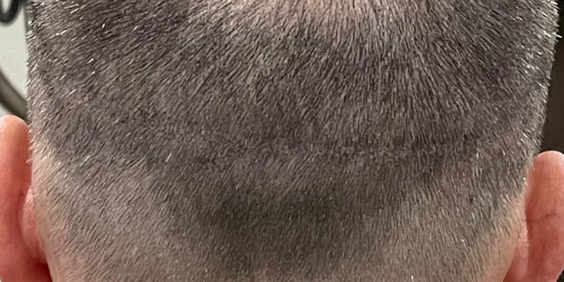 Scalp Micropigmentation Before & After Gallery - Patient 41625682 - Image 6