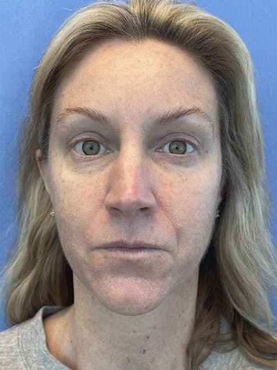 Bio Facial Before & After Gallery - Patient 50245074 - Image 1