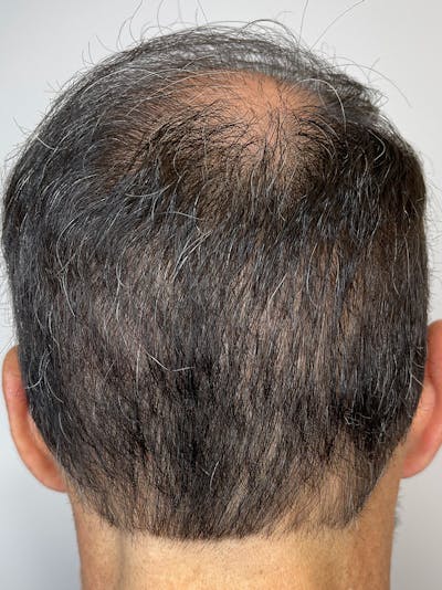 Scalp Micropigmentation Before & After Gallery - Patient 55474876 - Image 1