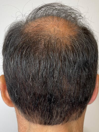 Scalp Micropigmentation Before & After Gallery - Patient 55474876 - Image 2