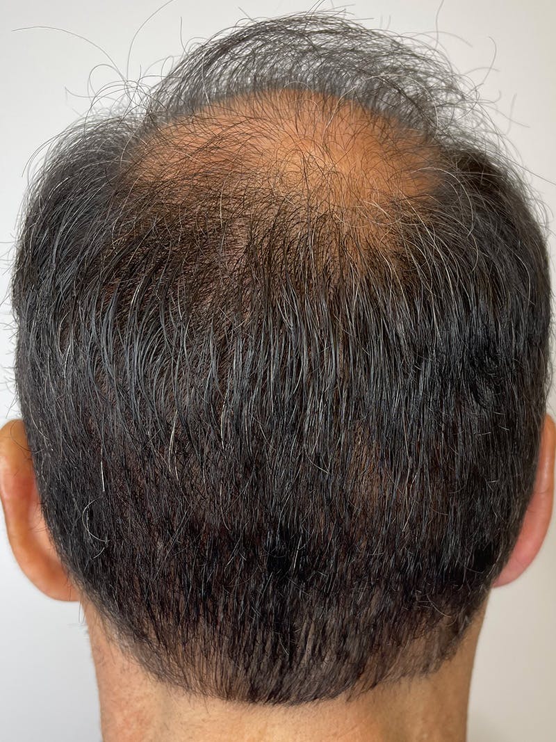 Scalp Micropigmentation Before & After Gallery - Patient 55474876 - Image 2