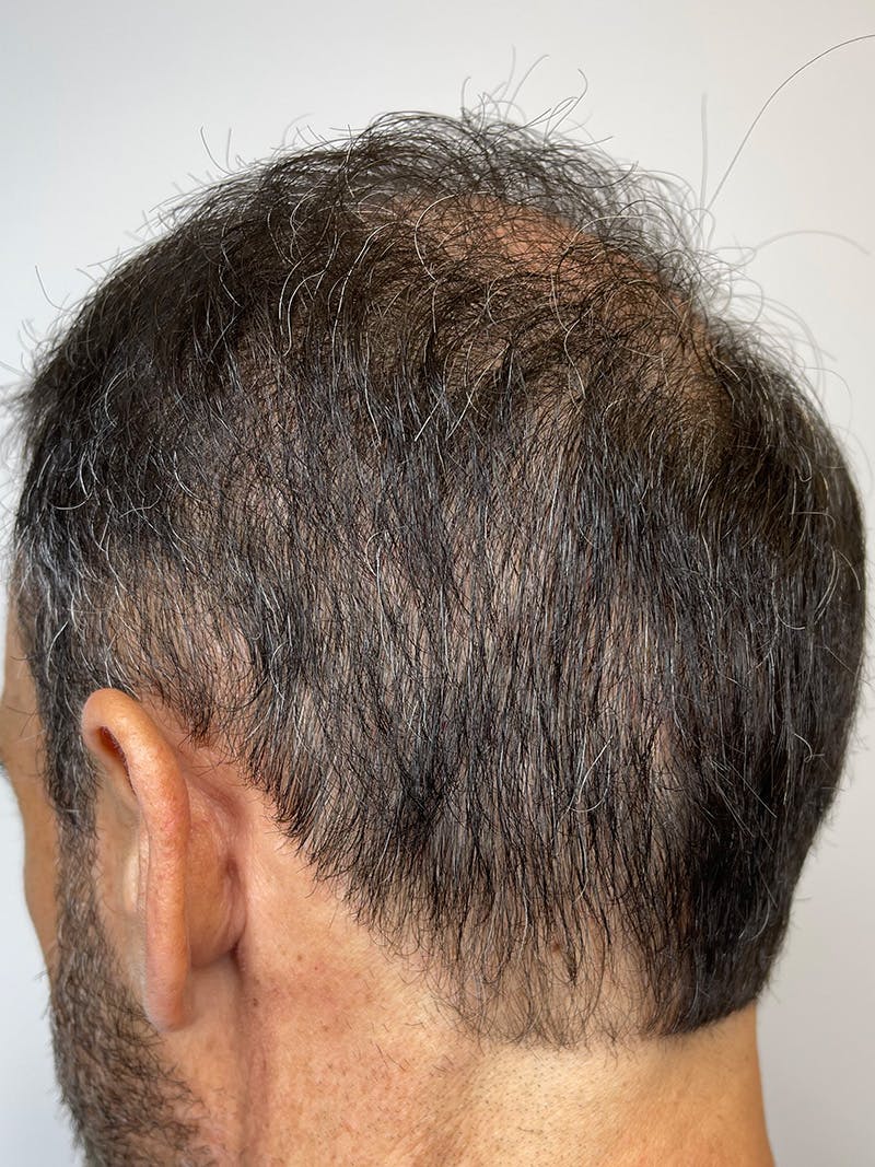 Scalp Micropigmentation Before & After Gallery - Patient 55474876 - Image 3
