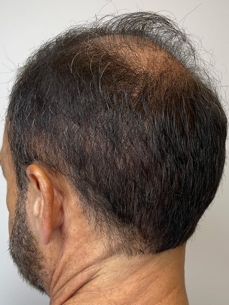 Scalp Micropigmentation Before & After Gallery - Patient 55474876 - Image 4