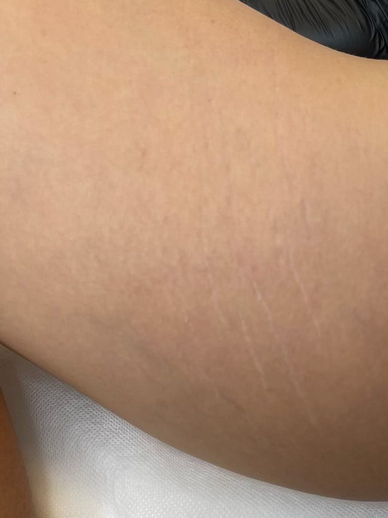Inkless Scar Camouflage Before & After Gallery - Patient 55474878 - Image 2