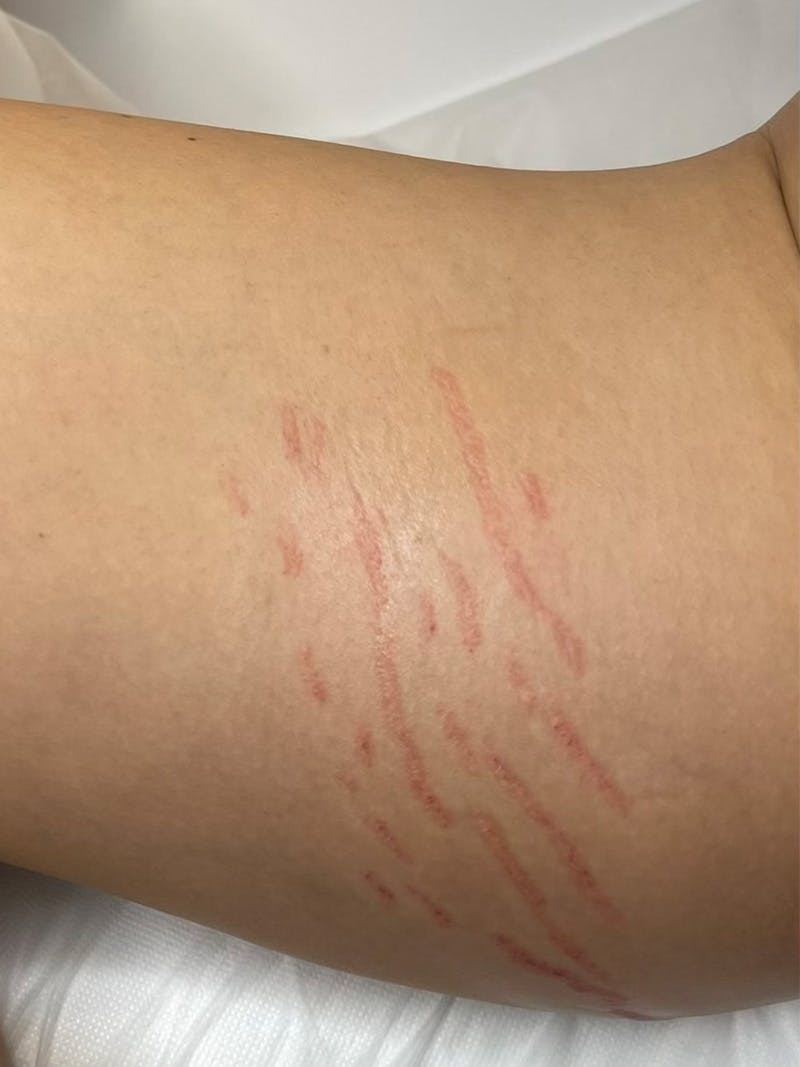 Inkless Scar Camouflage Before & After Gallery - Patient 55474878 - Image 1