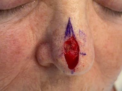 Mohs Surgery Before & After Gallery - Patient 63799210 - Image 1