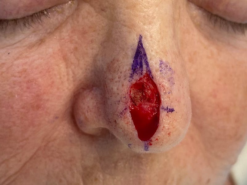 Mohs Surgery Before & After Gallery - Patient 63799210 - Image 1