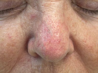 Mohs Surgery Before & After Gallery - Patient 63799210 - Image 2