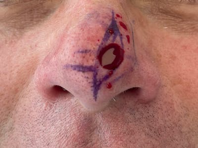 Mohs Surgery Before & After Gallery - Patient 63799211 - Image 1