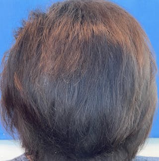 Non-Surgical Before & After Gallery - Patient 63793856 - Image 4