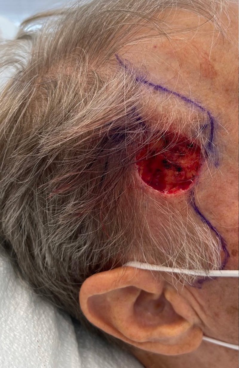 Mohs Surgery Before & After Gallery - Patient 63799217 - Image 1