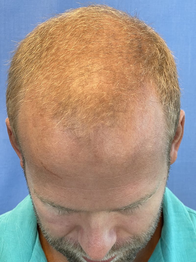 Surgical Before & After Gallery - Patient 63988803 - Image 3