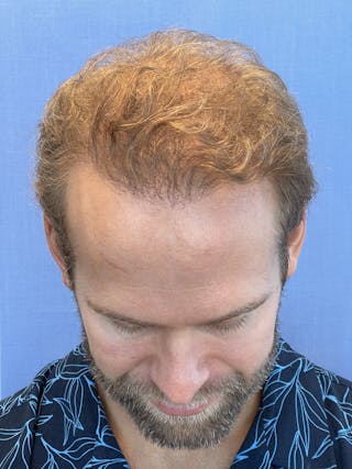 Surgical Before & After Gallery - Patient 63988803 - Image 4